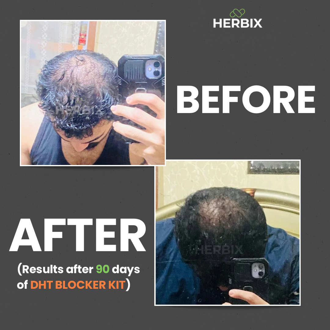 DHT Blocker (Hairloss)