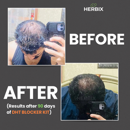 DHT Blocker (Hairloss)