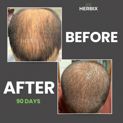 DHT Blocker (Hairloss)